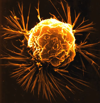 سلول سرطانی2